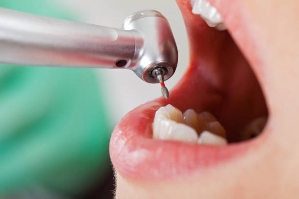 Best Emergency Tooth Extraction in Waverly, TN